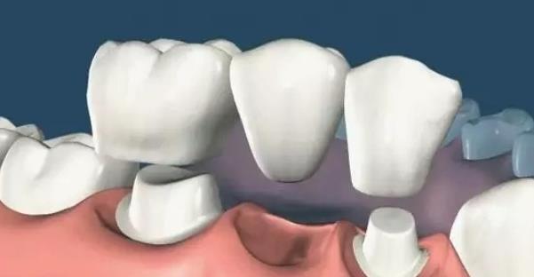 补一颗烤瓷牙多少钱？烤瓷牙的利弊、注意事项揭晓！