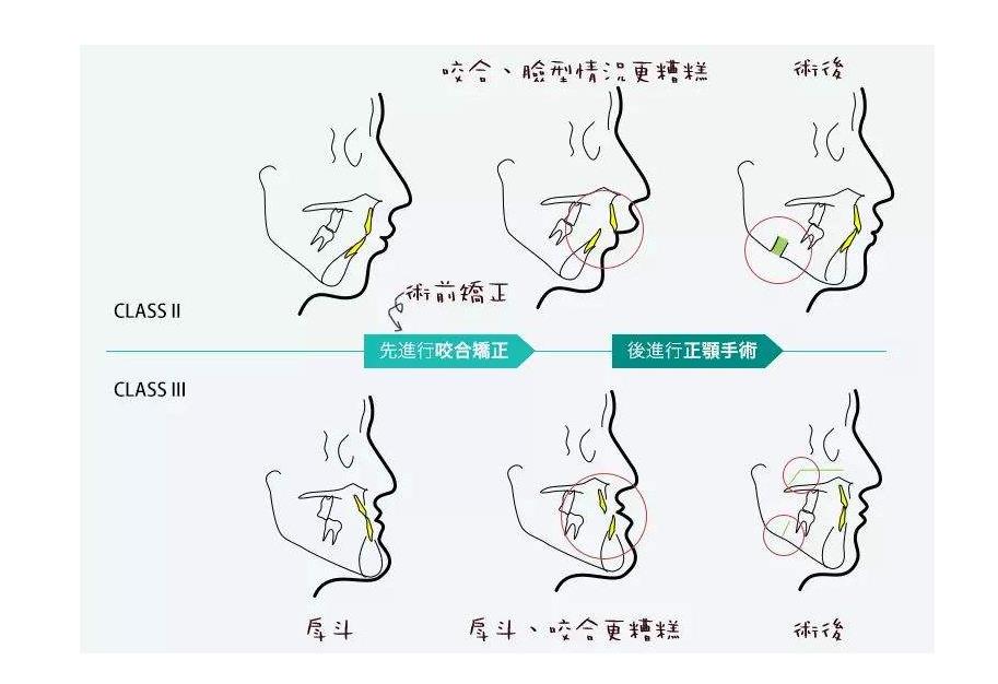 四川友谊医院磨骨多少钱？费用价格-赵延峰、李继华医生简介-案例参考