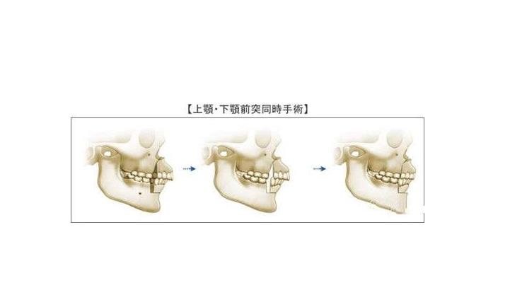 四川友谊医院磨骨多少钱？费用价格-赵延峰、李继华医生简介-案例参考