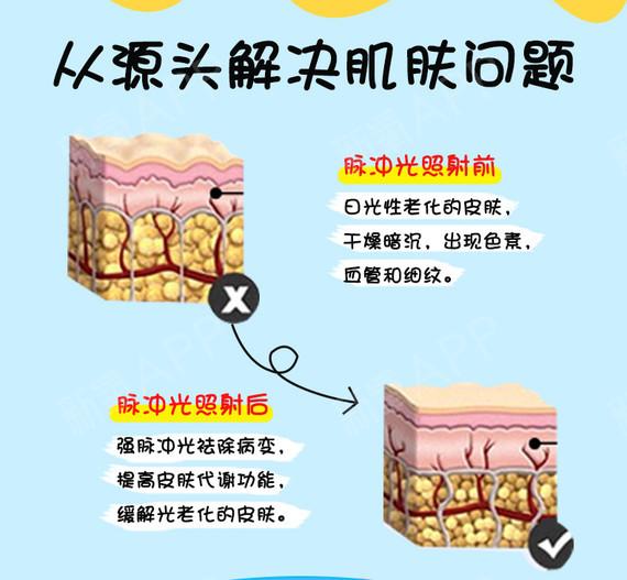 上海九院皮肤美容科要预约吗？哪个医生好？专家信息&光子嫩肤案例