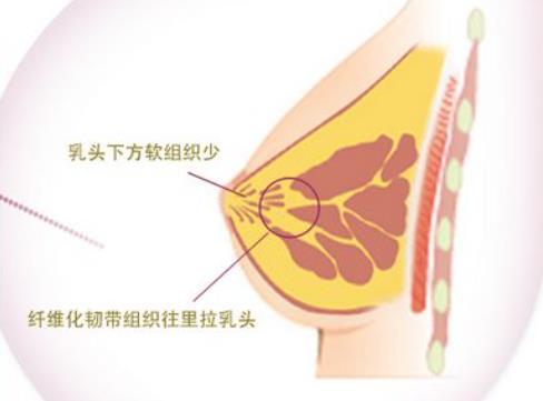 硅胶隆胸后遗症有哪些？手术后要注意哪些事情呢？