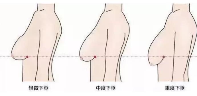 南方医科大学南方医院鲁峰医生做隆胸手术过程曝光！附上价格表哦