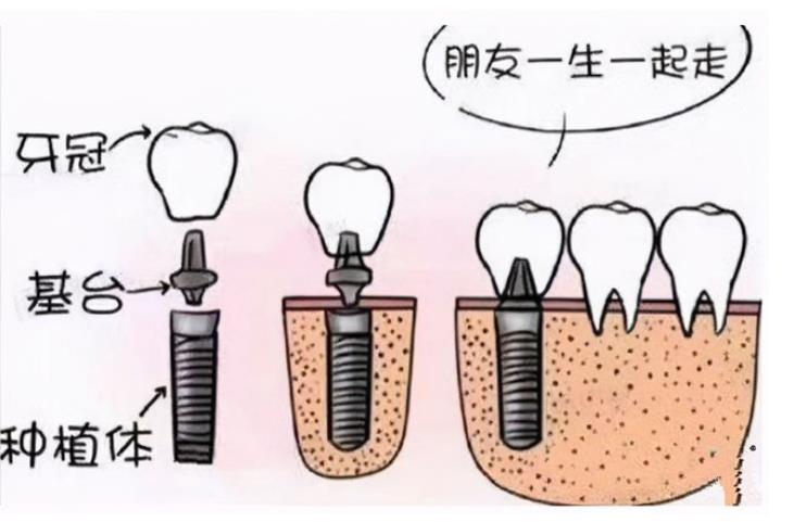 石家庄种植牙价格多少钱一颗？2023收费明细-种植牙原理