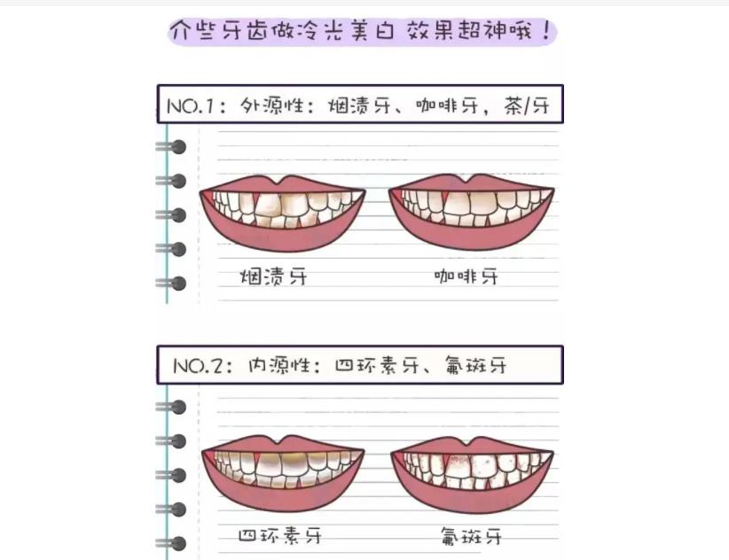 北京杰康口腔洁牙多少钱一次？价格收费标准-洁牙案例