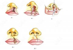 调节兔唇的费用大概是多少？兔唇形成原因盘点！