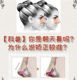 朝天鼻整形案例如何?实力案例全面盘点,“塌鼻星人”别错过!