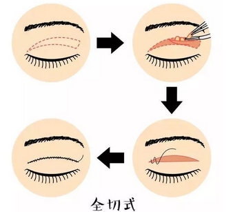 王太玲医生做双眼皮怎么样?教你认识真实术后案例!放大你的双眼~