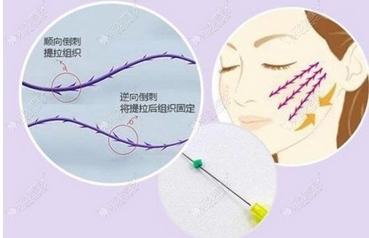 上海时光整形外科医院好不好?科室医生擅长什么项目呢?附埋线提升真实案例~
