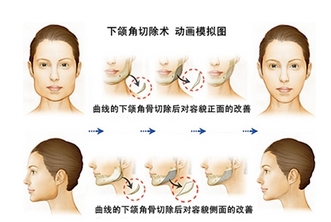 下颌角整形需要多少钱？医院资料-术后注意事项开展~让脸蛋更漂亮自然！