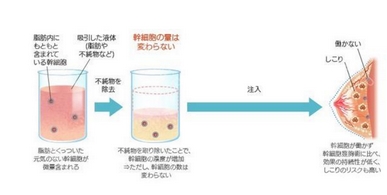 脂肪填充丰胸维持多久？哪些人适合做自体脂肪隆胸？的S曲线秀出来！