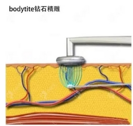 钻石精雕技术成熟了吗？抽脂时需要打膨胀液吗？术后护理也需要注意！