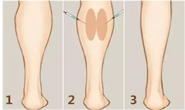小腿吸脂对比果怎么样？分享：小腿吸脂减肥术中分享，果一目了然！