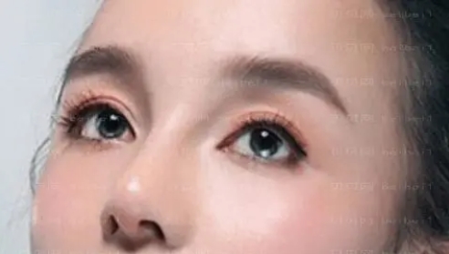 皮庆猛做双眼皮怎么样？技术特长介绍，双眼皮案例揭秘！