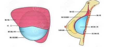 北京王驰隆胸怎么样？隆胸科普指南！美容简介-医生信息隆胸前必看~