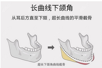 下颌角整形对比照片怎么样？磨骨整形方法有哪几种？口碑评价通篇看~