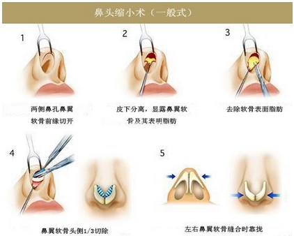 缩鼻头鼻翼手术危险吗？怎么样避免收缩鼻翼手术后出现危险？缩鼻头鼻翼必看！