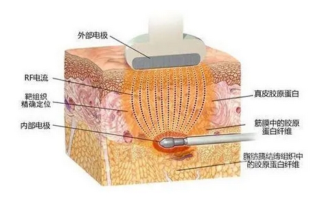 激光溶脂副作用有哪些？想瘦，注意事项先搞清楚！修长少不了ta~