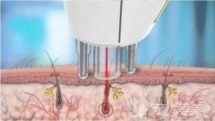 温医二院可以做激光脱毛吗？安全吗？夏日脱毛先别急，先注意这几点！