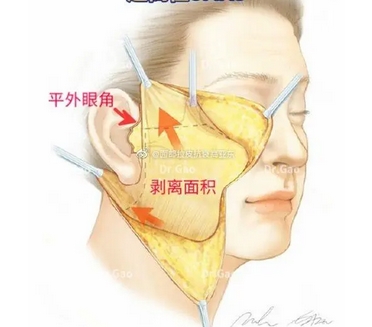 北京华韩高亚东和谢立宁拉皮手术怎么样？内含医生个人资料、风格解读！