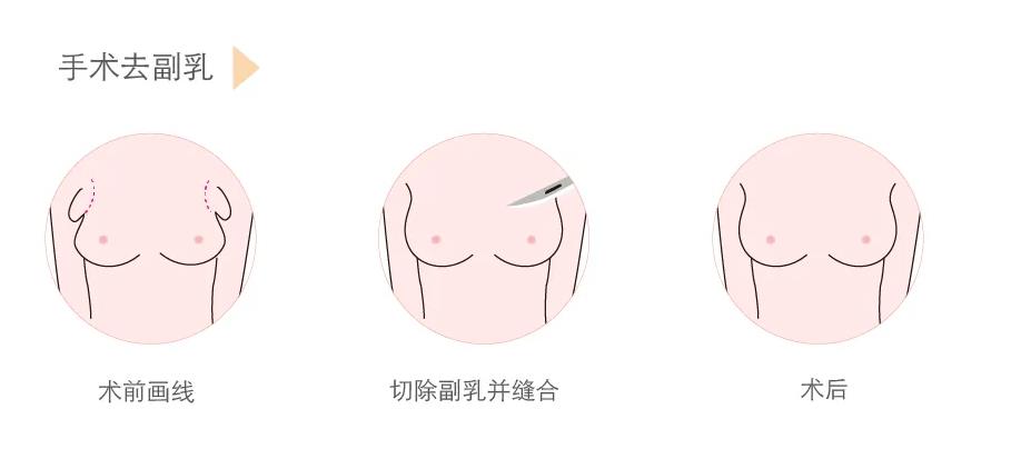 协和医院朱琳副乳手术技术如何？医生简介-近期案例-收费标准