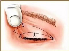 眼尾下垂做双眼皮还是提眉好？对比这两种方法的优缺点便知晓！美眼不简单啊~