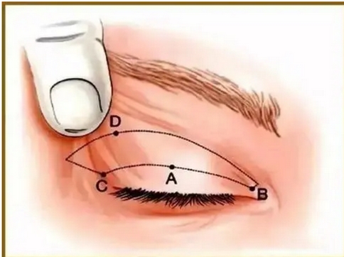 眼尾下垂做双眼皮还是提眉好？对比这两种方法的优缺点便知晓！美眼不简单啊~
