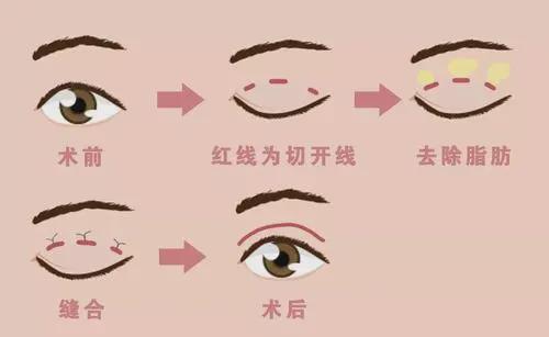 成都何军做双眼皮怎么样？医生简介-价格表2023！眼整形大咖测评