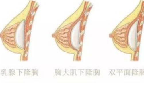 徐华隆胸怎么样？医生个人资料介绍,附价格表参考