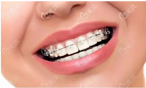 深圳阳光牙齿矫正价格怎么样？真实案例测评介绍！反手就是一个收藏~