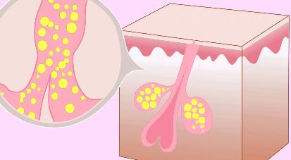 痘博士祛痘是不是真的？痘痘是这样子形成的！