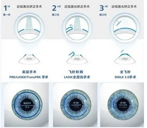 北京近视眼激光手术价格如何？使眼睛达到良好视觉质量！摆脱“眼睛仔”称号~