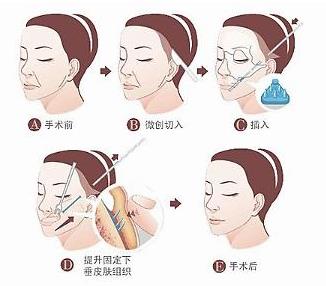小切口拉皮和筋膜悬吊的区别是什么？操作方式相差很多！