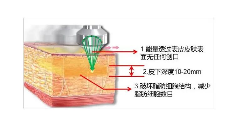 脸部超声波的效果如何？紧致肌肤、提拉塑型都还不错！