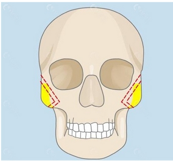 颧骨磨骨和颧骨内推哪个风险大？有哪些区别？“换头”后惊艳登场！