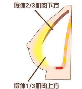 隆胸修复术要多久恢复？术后注意事项有哪些，助你重塑波涛！花一分钟了解一下~