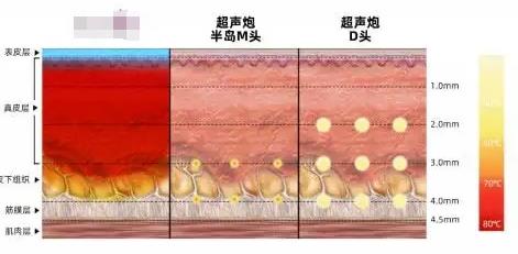 半岛超声炮可以维持多久？全脸做一次多少钱？初抗指南~