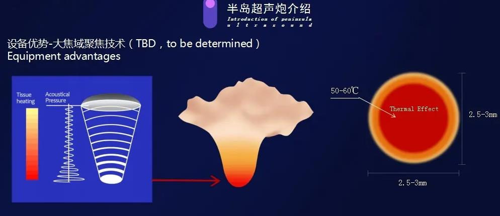 超声炮一般全脸打多少发？超声炮痛不痛？和超声刀的区别盘点