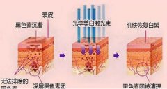 光子嫩肤一到七天图恢复过程:肌肤变得更光滑，毛孔也细腻~