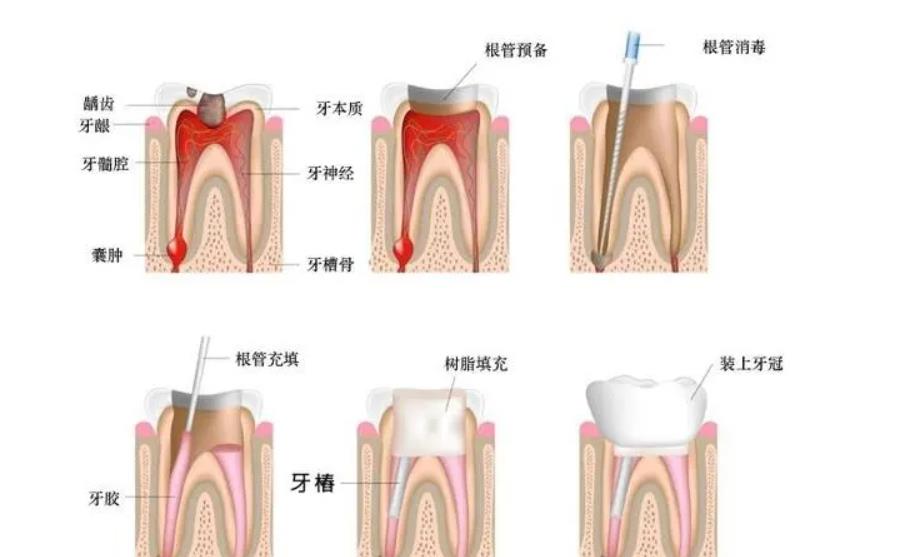 劲松口腔做根管调节怎么样？多少钱？专业医生简介-收费标准