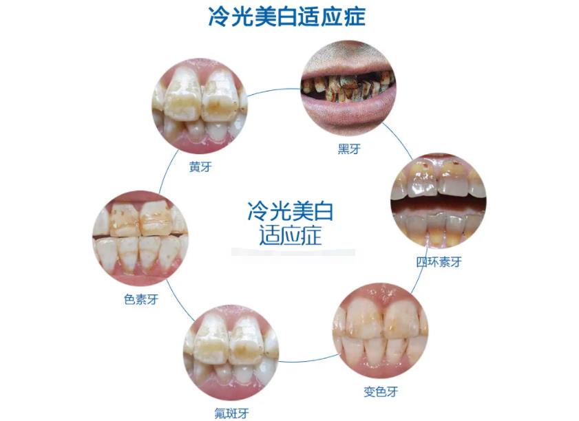 北京大兴兴业口腔医院是公立吗？预约指南！内附冷光美白案例