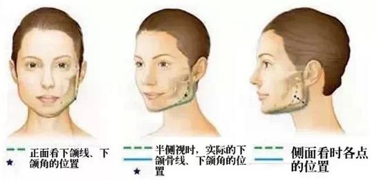 上海华美做下颌角怎么样?李志海医生技术测评_经典案例详情