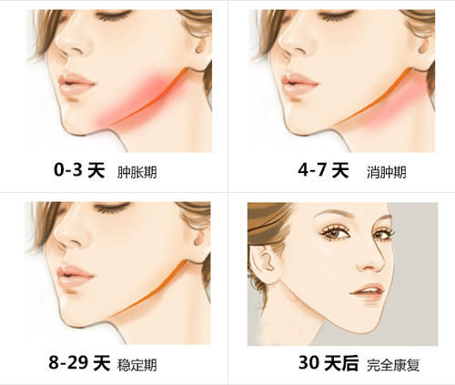 上海华美做下颌角怎么样?李志海医生技术测评_经典案例详情