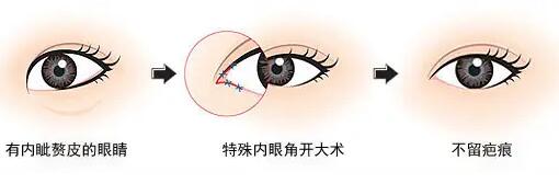 陈霞做内眼角开大好吗？效果怎么样？来看详细介绍