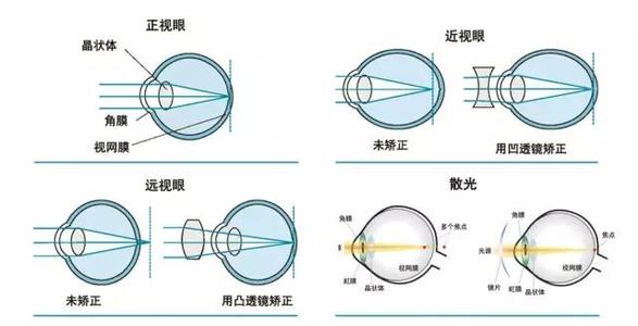 上班族近视激光手术好吗？多少钱？价格表_原理抢先看！