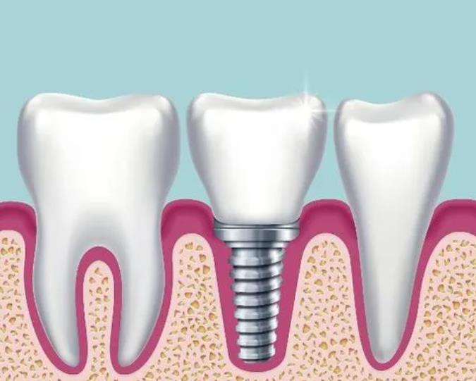上海天使口腔门诊部种植牙价格多少？牙齿种植的原理是什么？科普