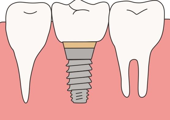 上海天使口腔门诊部种植牙价格多少？牙齿种植的原理是什么？科普