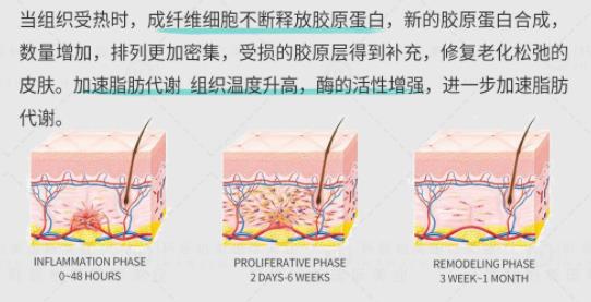 7d聚拉提适合多大年龄做？原理、价格影响因素汇总！初抗指南~