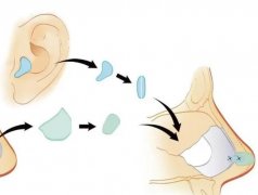 自体软骨隆鼻的优缺点\恢复期超全盘点！气质鼻型get指南~