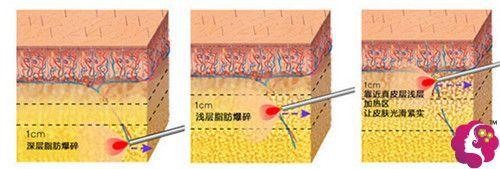 激光溶脂瘦脸的危害有哪些？刺痛、肿胀、疤痕等！附优点介绍