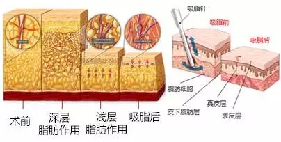 蓉美和谐医疗美容吸脂怎么样？成都医美机构实力_收费_腰腹吸脂案例